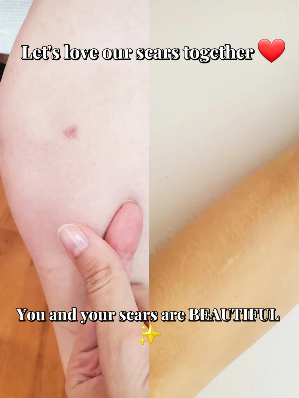 Trigger Warning] There are about 130 scars on my thighs. Would