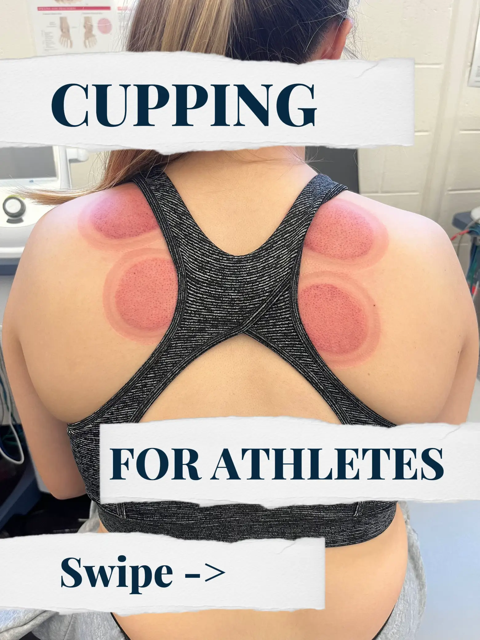 Dry Cupping Benefits - Lemon8 Search