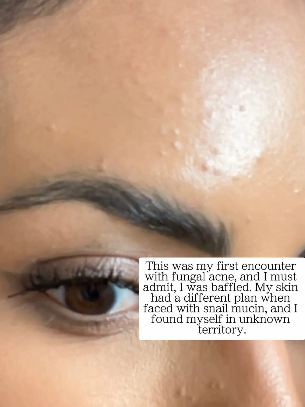 Viral Snail Mucin Destroyed My Skin | Gallery posted by Rosey Sera 