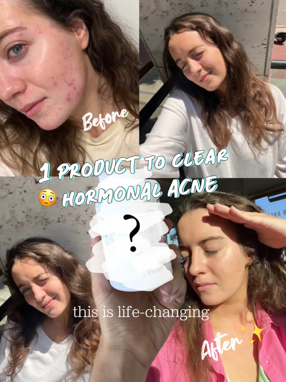 Alani sale nu acne