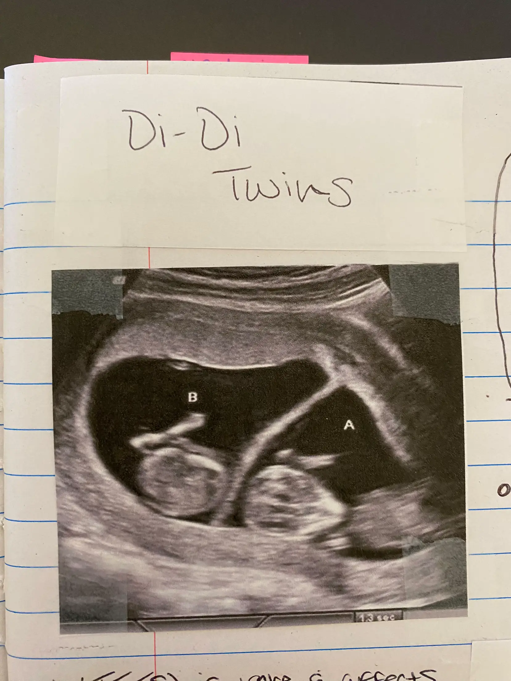 Fetus Twins - Lemon8 Search