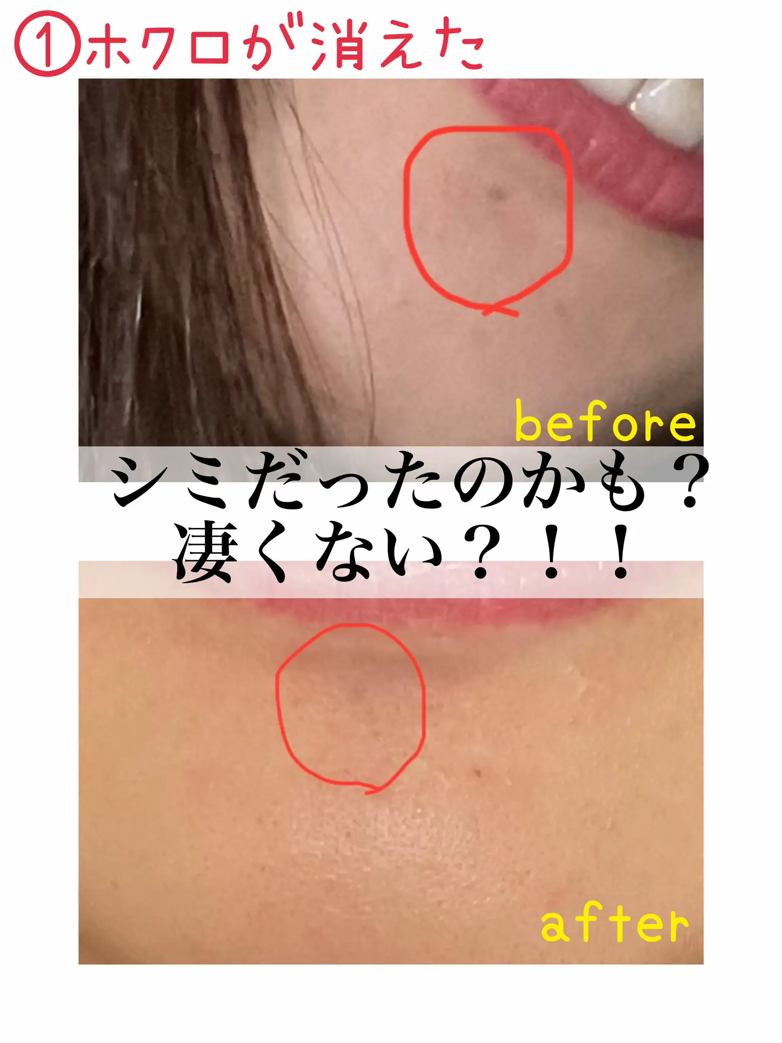 ホクロ(シミ?)が消えた! | ₦|プチプラで美白美肌🐻❄️が投稿した