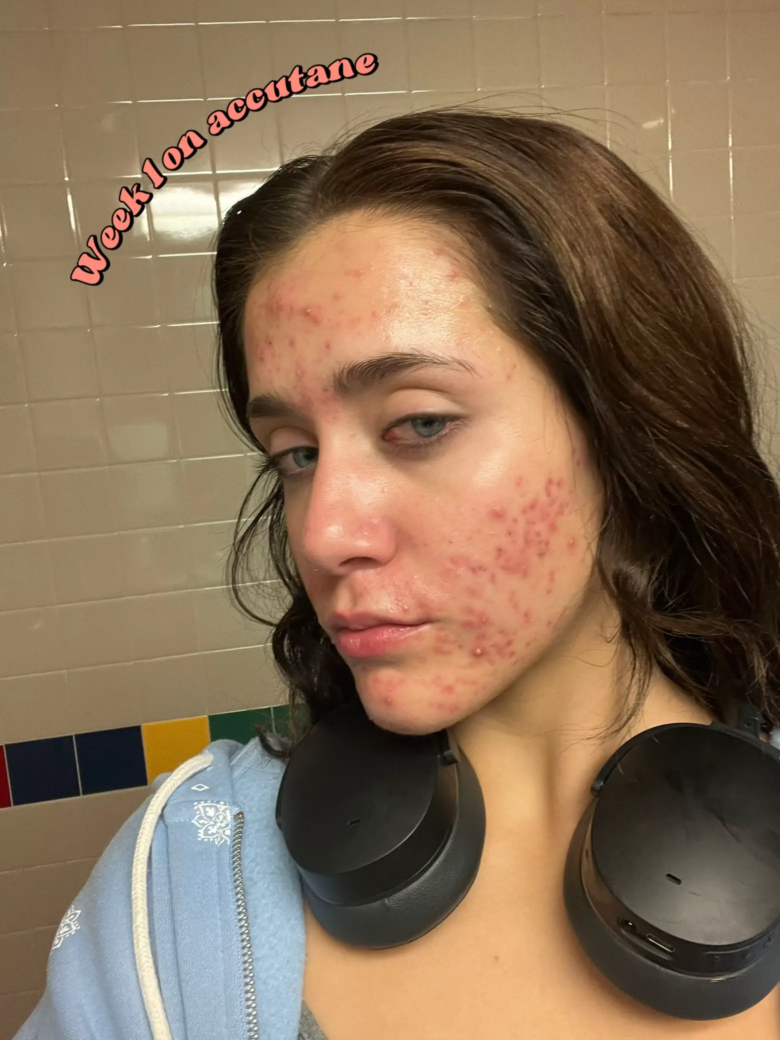 Week 1 on accutane | Gallery posted by Octavia | Lemon8