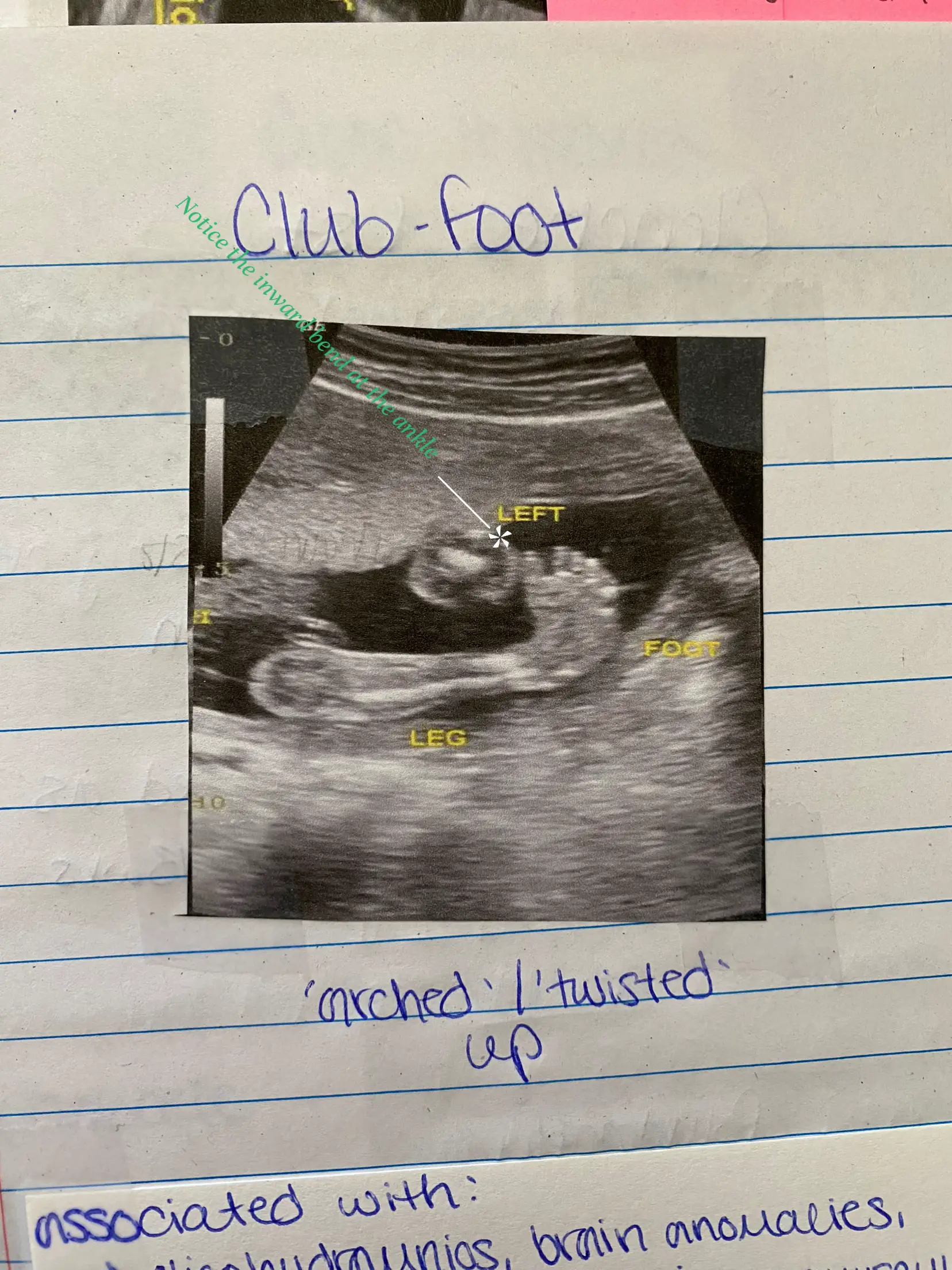  A drawing of a baby's leg with a note that says "LEFT FOOT LEG" above it.