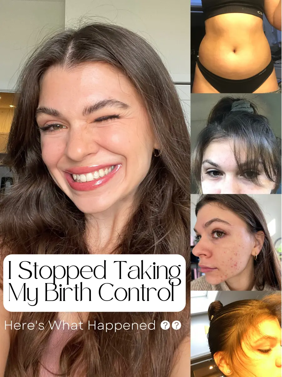 sorry this is so long but 13 years is a lot to cover! #hormonalacne #, getting  off birth control