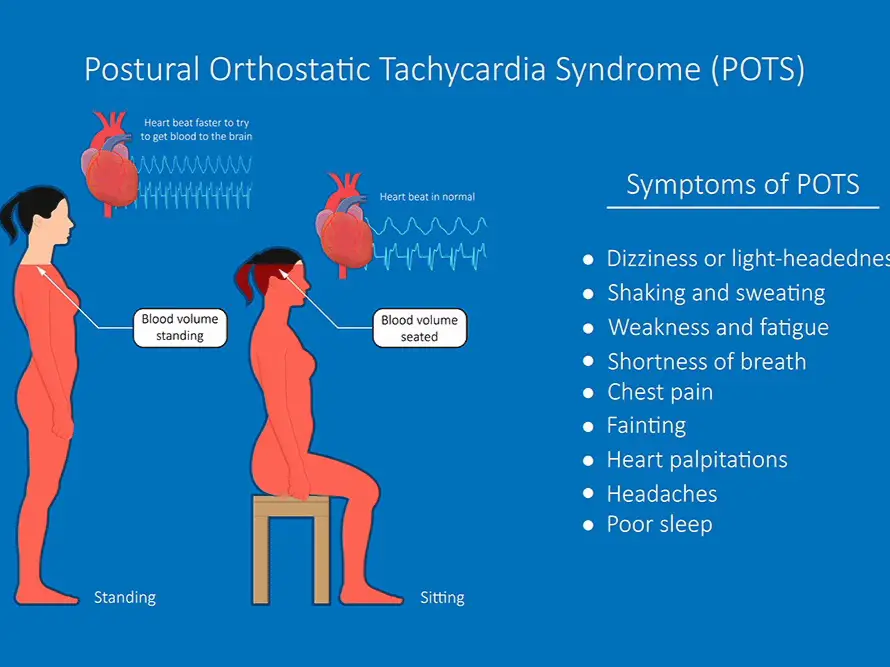 Standing Up to POTS on X: We have been busy creating new infographics  about postural orthostatic tachycardia syndrome (POTS), and hope that you  will check them out on our newest webpage! You
