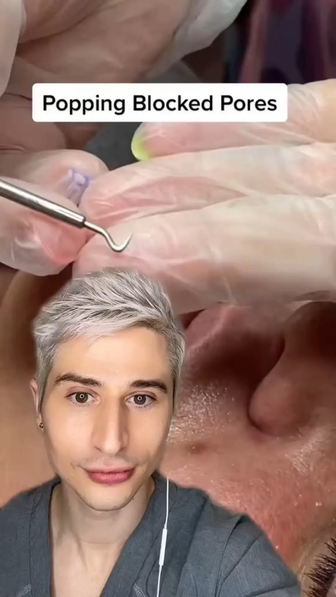 Perfect Pimple Popping Technique Video published by DermAngelo Lemon8