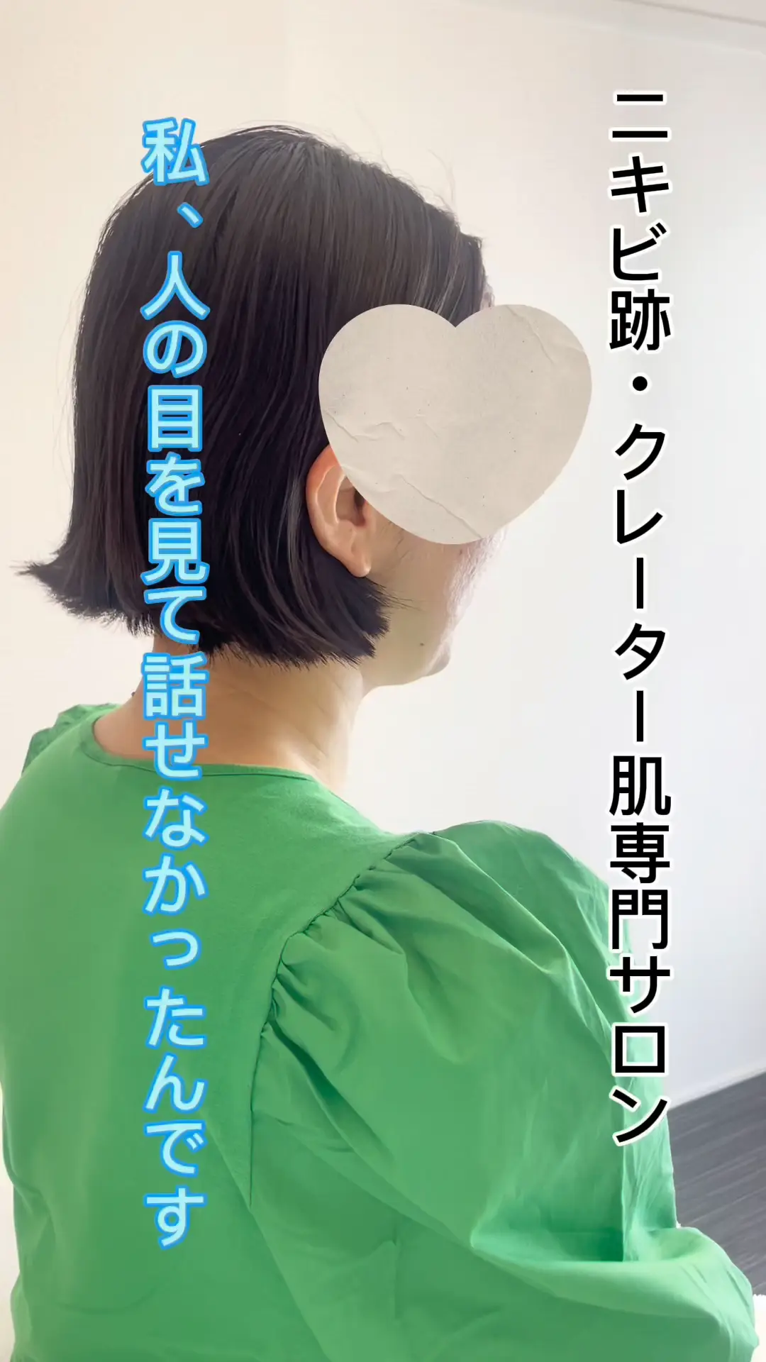 痛くない方法があるんだ！やっと治療以外の方法を見つけた！ロゼルナはダウンタイムゼロのクレーターケア