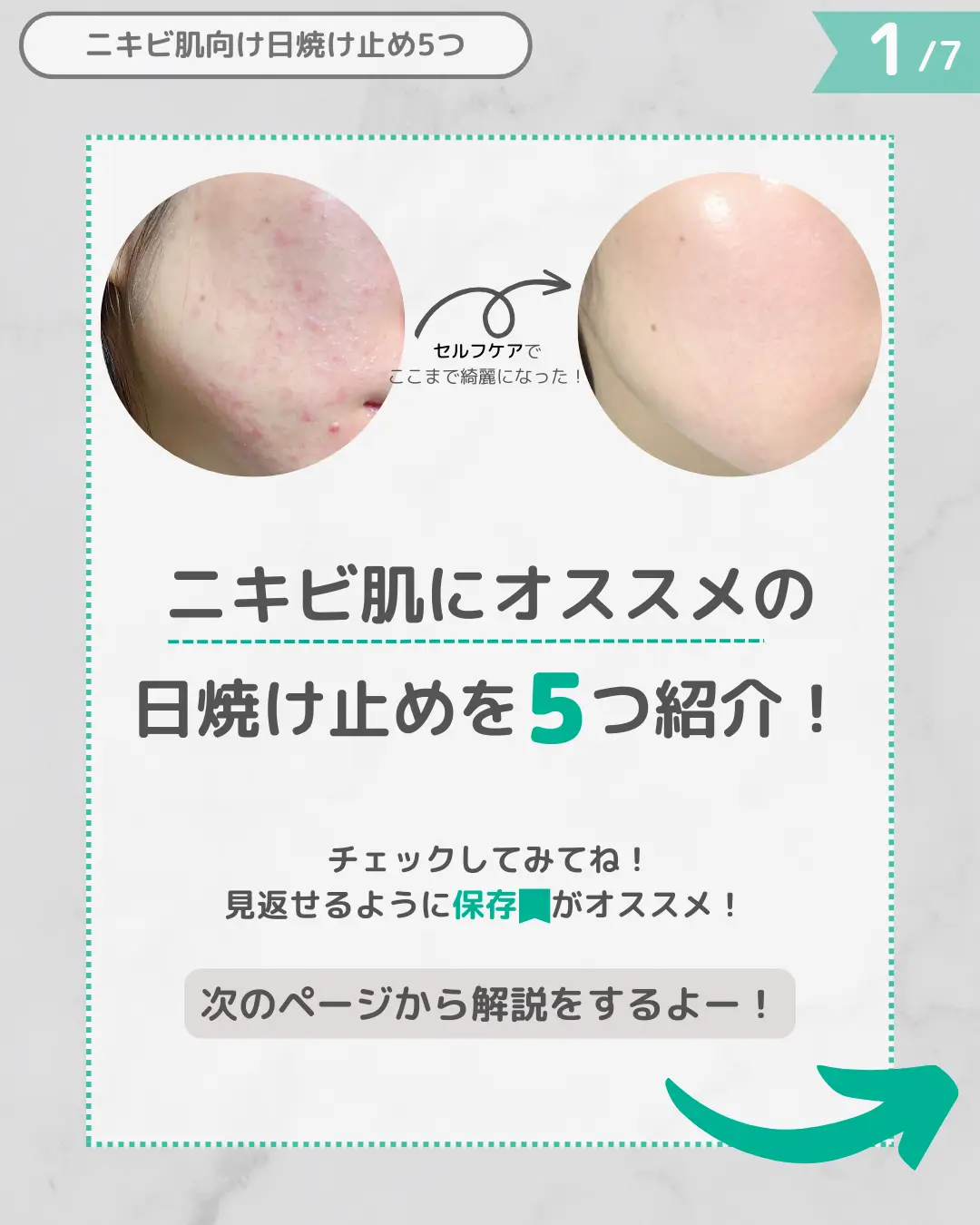 For acne skin] sunscreen | Gallery posted by うに | 大量ニキビを治