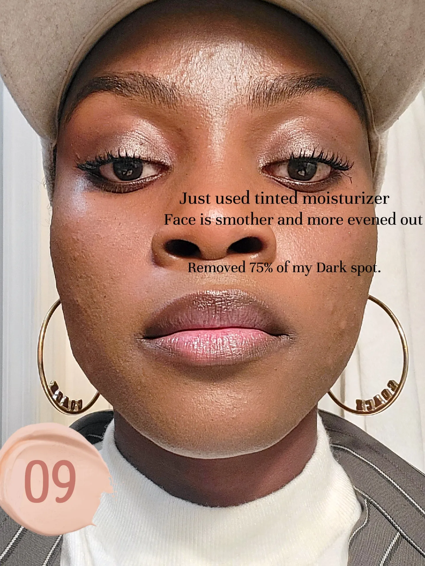 Deep Chemical Peel Journey For 2024 Gallery Posted By TheBioChemist deep-chemical-peel-journey-for-2024-gallery-posted-by-thebiochemist