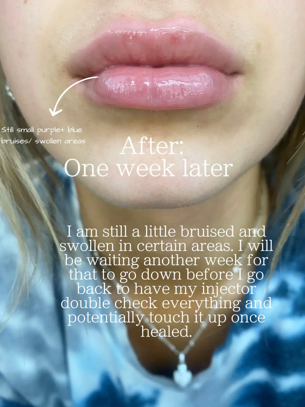 recovering from lip enhancement treatment - Lemon8 Search