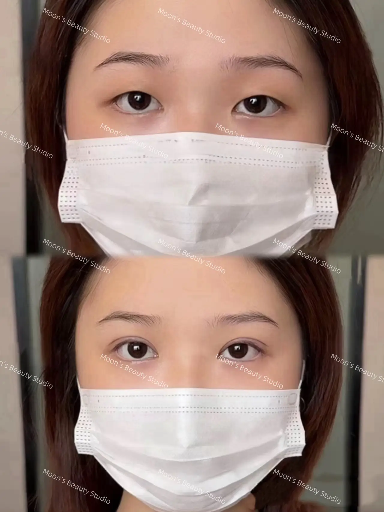 Noninvasive Double Eyelid | Moon's Beautyが投稿したフォトブック | Lemon8