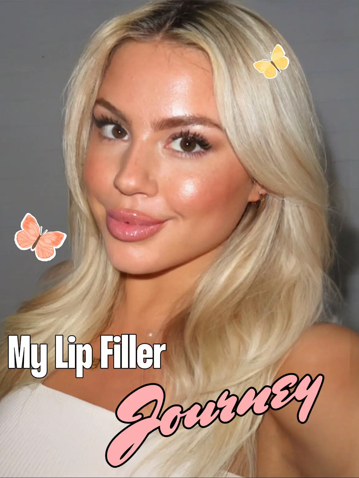 💋Lip Filler ✨The goal was to improve lip volume and hydration by  maintaining the natural look of her already gorgeous lips! ✨Look at…