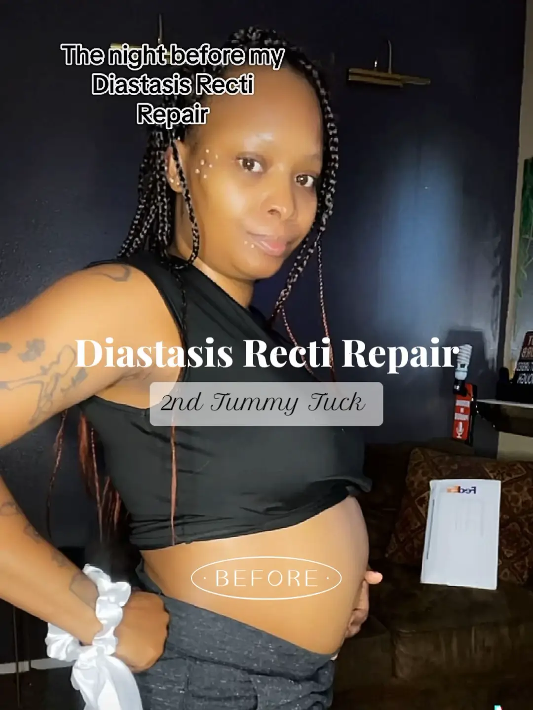 Diastasis Recti after Pregnancy- Symptoms and How to Recover - Sweet Skin  Liners