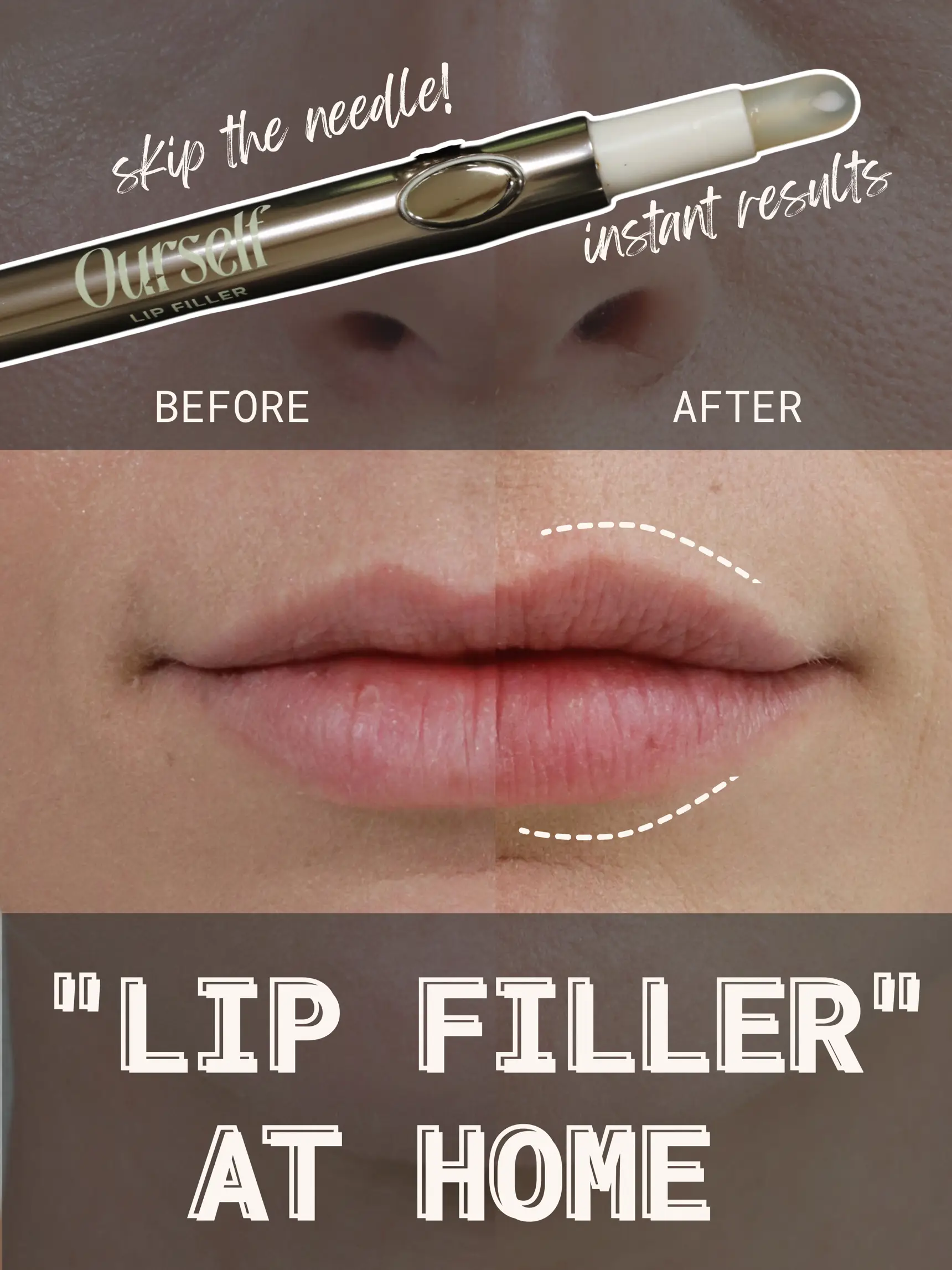 $145 subtopical lip filler!? …worth it?