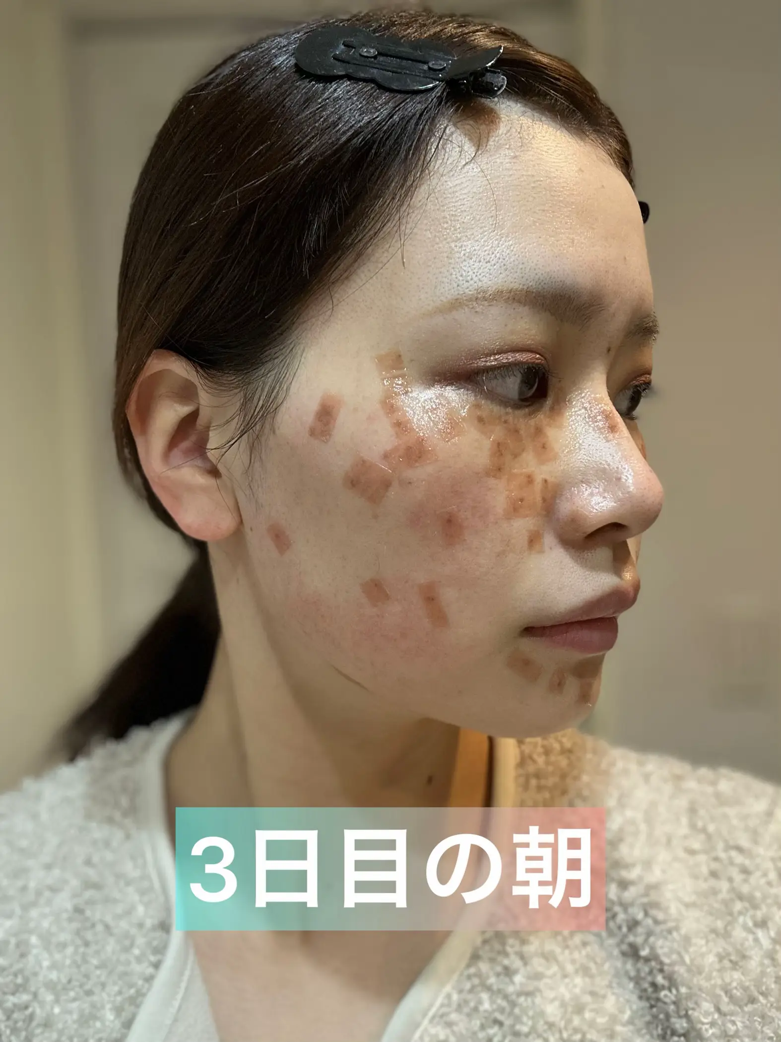 衝撃🫨シミ取り事情 | あぃみ515が投稿したフォトブック | Lemon8