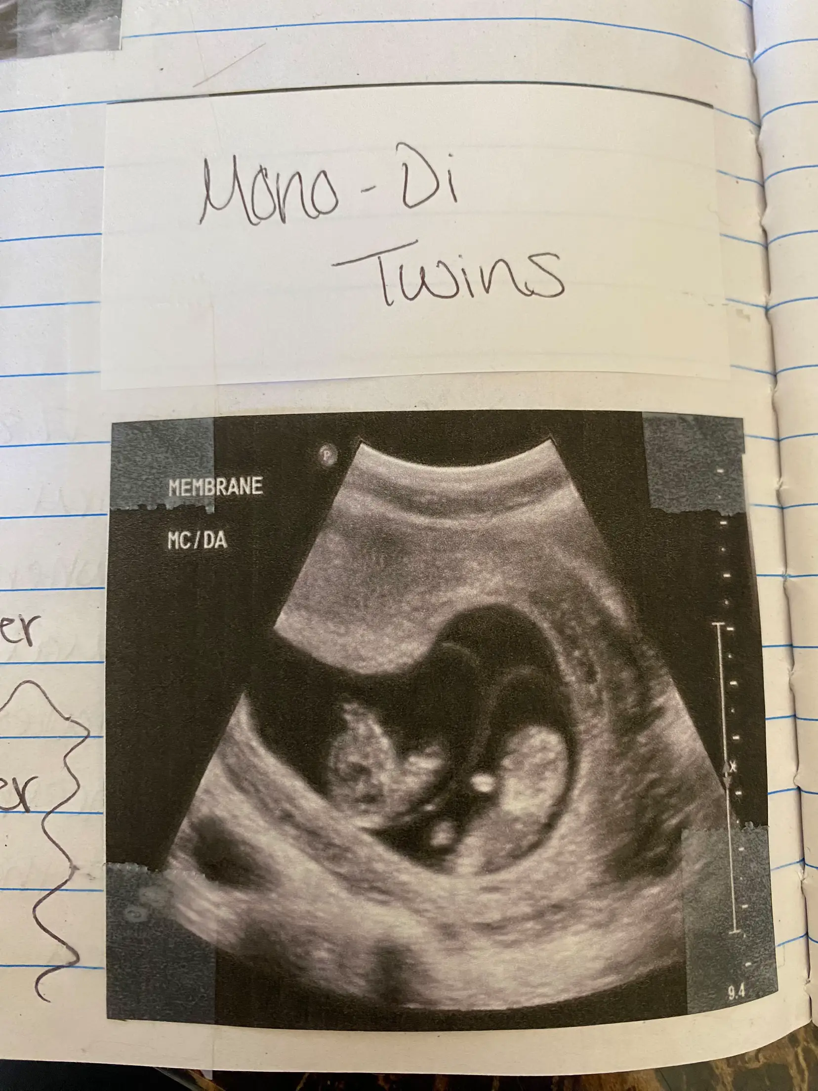 Fetus Twins - Lemon8 Search