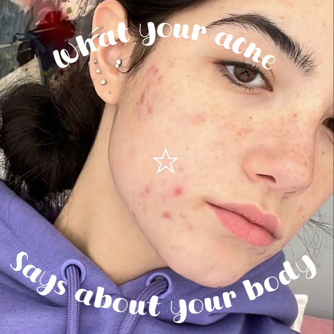 What your acne says about you 🫶🍋's images