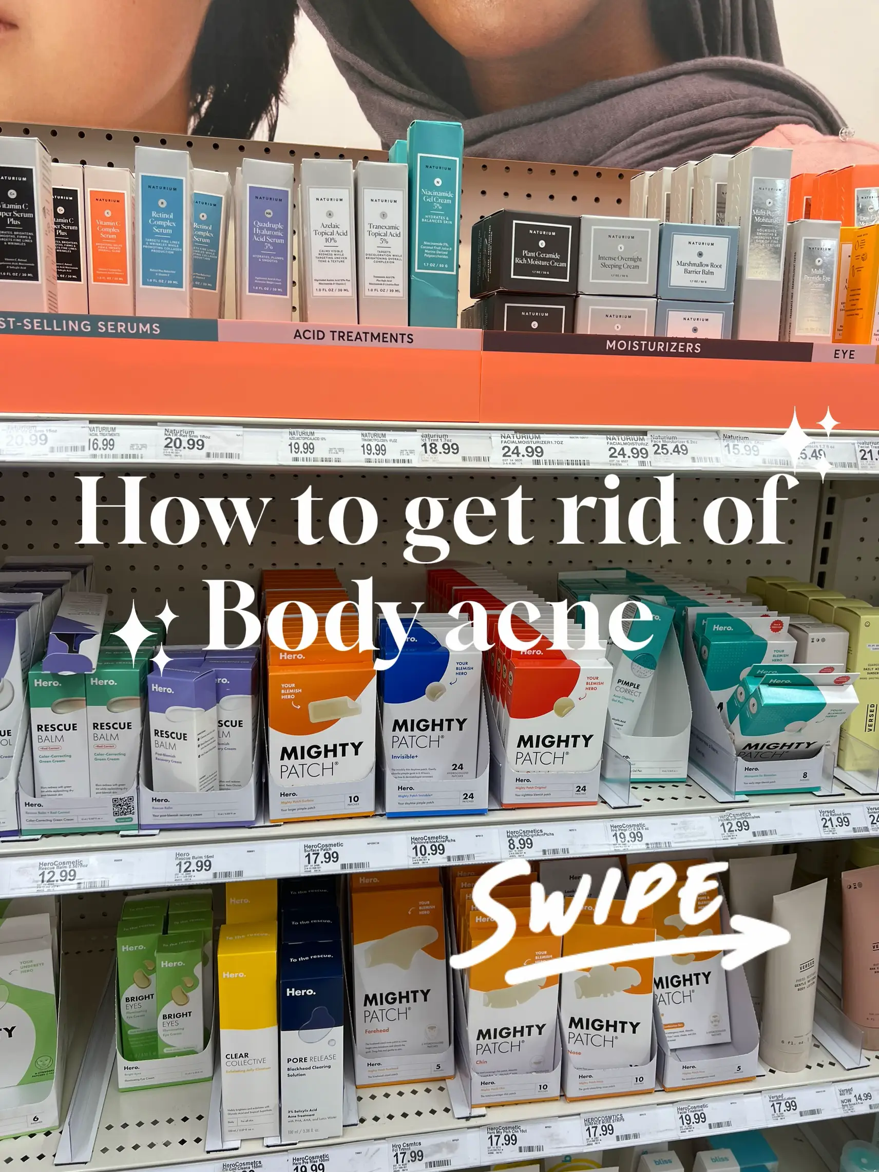 How to get rid of body acne's images