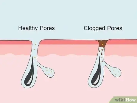 3 Ways to Clear Blackheads with Toothpaste - wikiHow