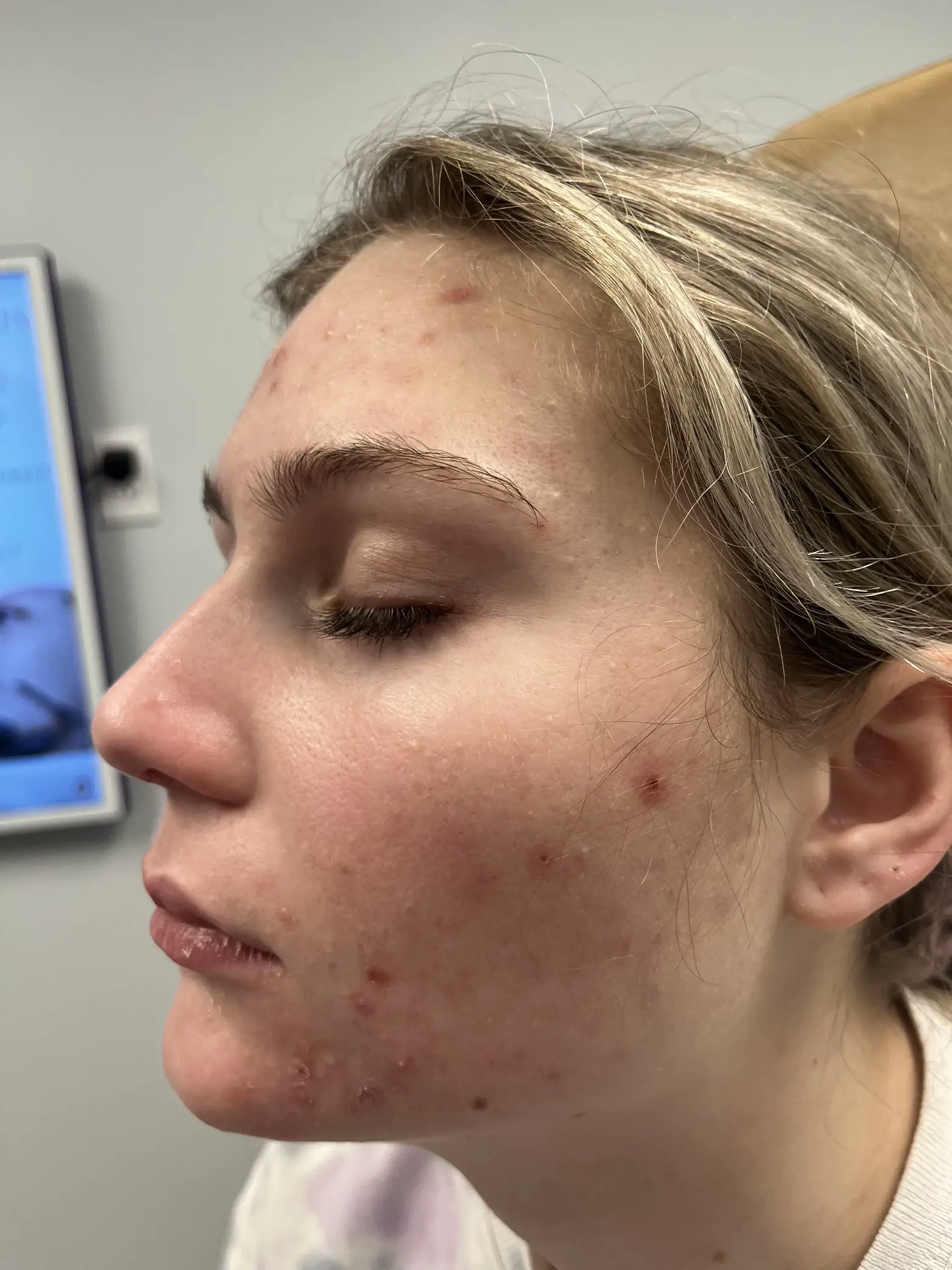 Accutane Moderate Acne Reddit Lemon8 Search