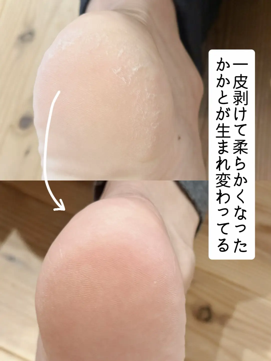 足の皮ズル剥け！生まれ変わった足🦶🥹💖 | あここアラフォー美容/が投稿したフォトブック | Lemon8