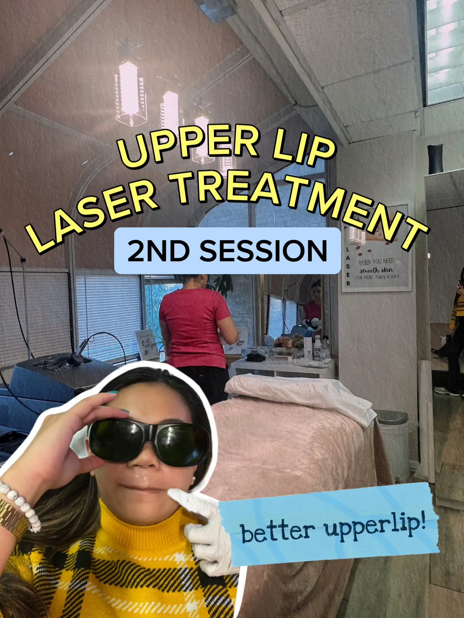 2nd session Upper lip Laser Treatment Gallery posted by Fin