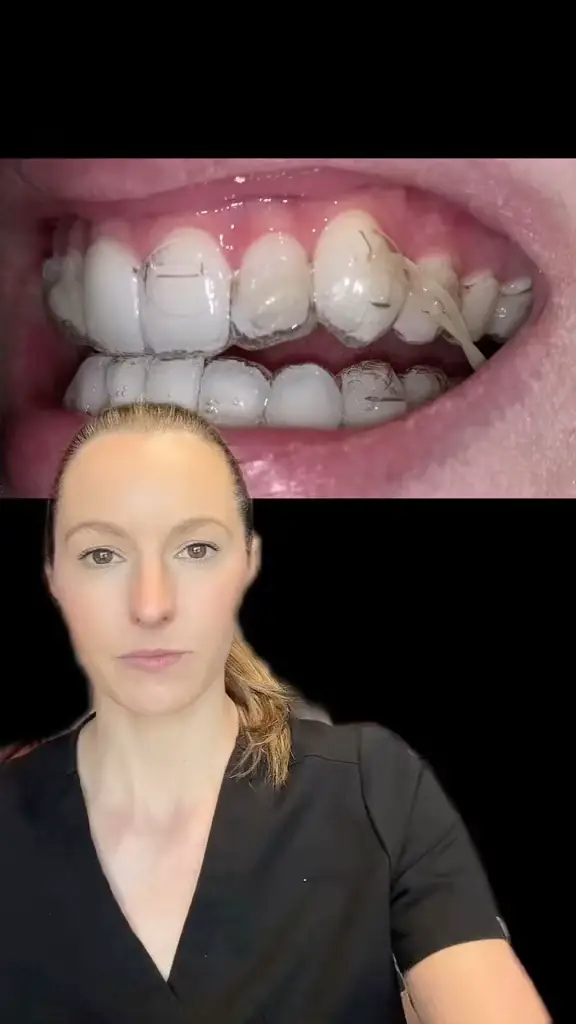 Evaluating Invisalign Tracking & Attachment Flash - The Ortho Cosmos