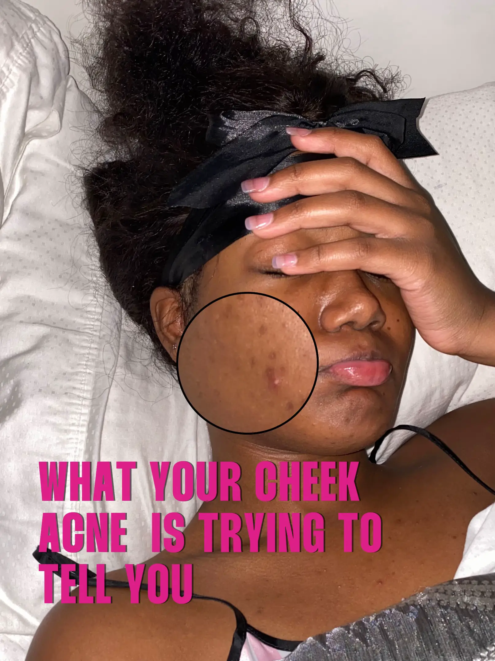 Breakouts on our cheeks tell us | Gallery posted by Laureen Taylor | Lemon8